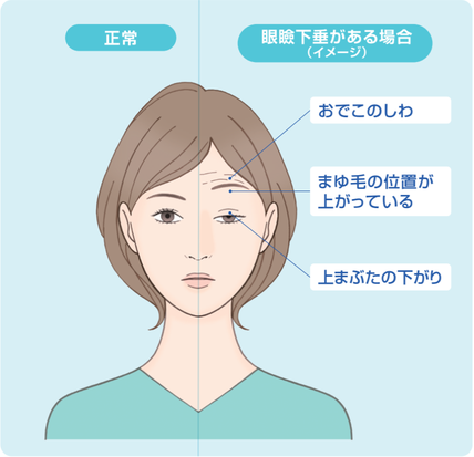 『眼瞼下垂』とは