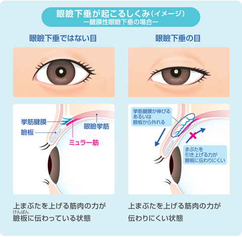 『眼瞼下垂』が起こるしくみ