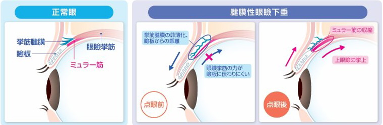 『アップニーク&reg; ミニ点眼液0.1％』の作用機序